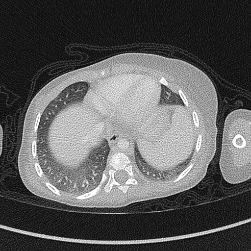 Beckwith-Wiedeman syndrome with bilateral Wilms tumors (Radiopaedia 60850-68629 Axial lung window 48).jpg