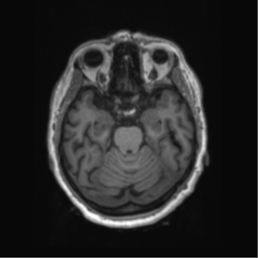 File:Behavioral variant frontotemporal dementia and late onset schizophrenia (Radiopaedia 52197-58083 Axial T1 72).png