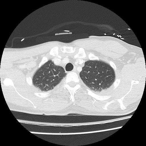 File:Benign post-traumatic pseudopneumoperitoneum (Radiopaedia 71199-81495 Axial lung window 20).jpg