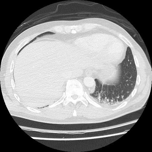Benign post-traumatic pseudopneumoperitoneum (Radiopaedia 71199-81495 Axial lung window 58).jpg