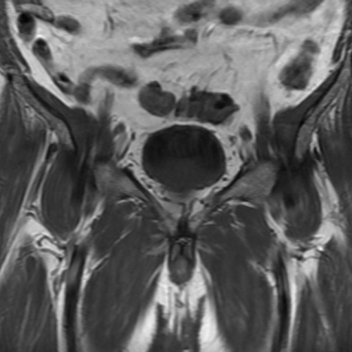 File:Benign prostatic nodular hyperplasia (Radiopaedia 16917-16634 Coronal T1 6).jpg