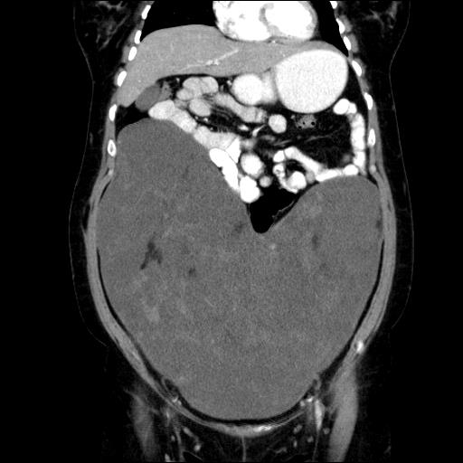 File:Benign spindle cell tumor - abdominopelvic (Radiopaedia 61300-69212 C 22).jpg