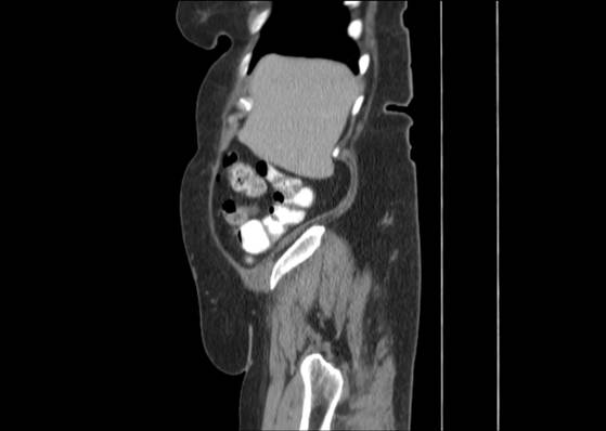 Bicameral celiacomesenteric aneurysm (Radiopaedia 55766-62327 B 10).jpg