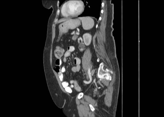 Bicameral celiacomesenteric aneurysm (Radiopaedia 55766-62327 B 38).jpg