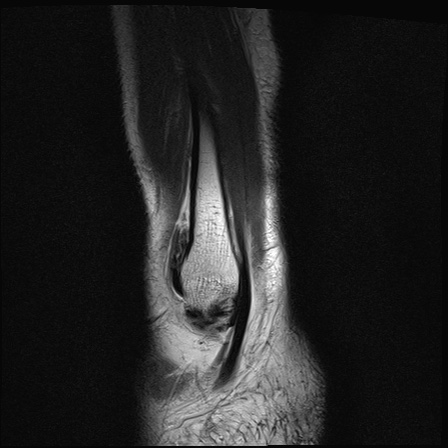File:Bilateral Achilles tendon complete tear (Radiopaedia 81344-95051 Sagittal T2 30).jpg