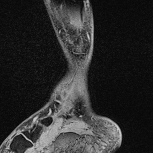 Bilateral Achilles tendon complete tear (Radiopaedia 81344-95051 Sagittal WE - Left 26).jpg