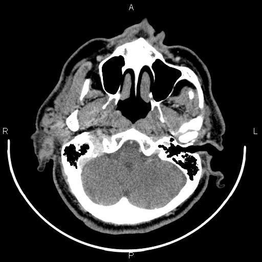 File:Bilateral Warthin tumors (Radiopaedia 84034-99263 Axial With contrast 11).jpg