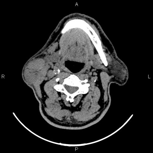 Bilateral Warthin tumors (Radiopaedia 84034-99263 Axial non-contrast 31).jpg
