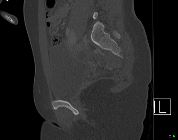 Bilateral acetabular fractures (Radiopaedia 79272-92308 Sagittal bone window 36).jpg