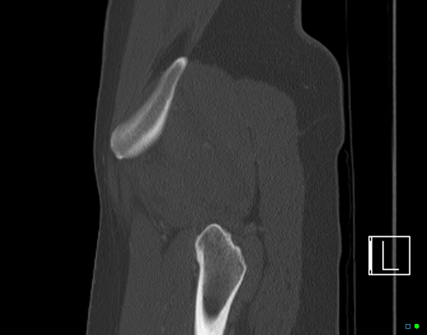 Bilateral acetabular fractures (Radiopaedia 79272-92308 Sagittal bone window 79).jpg