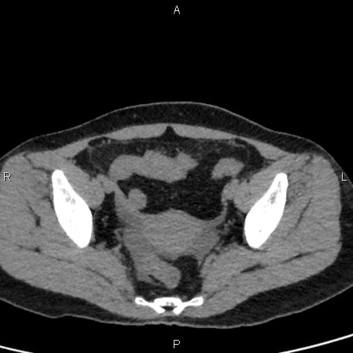 Bilateral adrenal gland hyperenhancement in pancreatitis (Radiopaedia 86642-102753 Axial non-contrast 96).jpg