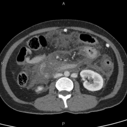 Bilateral adrenal gland hyperenhancement in pancreatitis (Radiopaedia 86642-102753 E 57).jpg