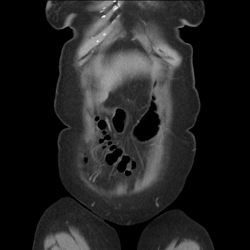 Bilateral adrenal granulocytic sarcomas (chloromas) (Radiopaedia 78375-91007 B 19).jpg