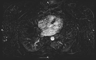 Bilateral adrenal myelolipoma (Radiopaedia 63058-71537 I 3).jpg