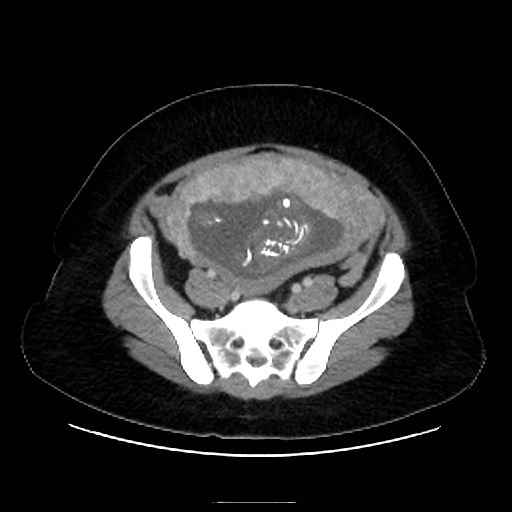 Bilateral adrenal thrombosis (Radiopaedia 58182-65256 A 58).jpg