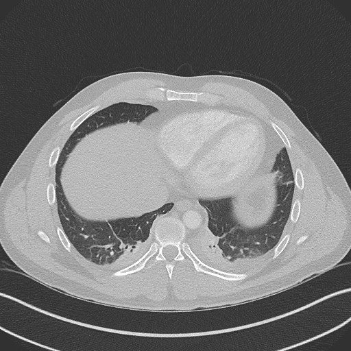 Bilateral atelectasis (Radiopaedia 48666-53675 Axial lung window 84).jpg