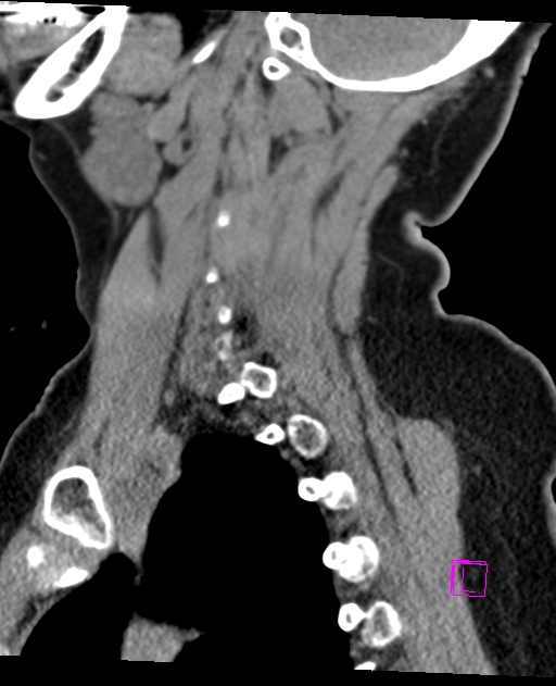 Bilateral atlanto-occipital assimilation (Radiopaedia 28350-28603 D 59).jpg