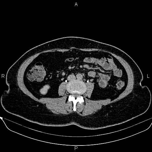 File:Bilateral benign adrenal adenomas (Radiopaedia 86912-103124 Axial C+ delayed 86).jpg