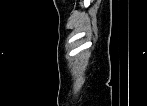 Bilateral benign adrenal adenomas (Radiopaedia 86912-103124 E 2).jpg