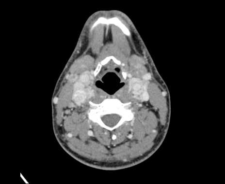 Bilateral carotid body tumors (Radiopaedia 61841-69870 Axial Post contrast 55).jpg