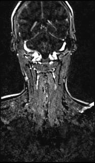 File:Bilateral carotid body tumors and right glomus jugulare tumor (Radiopaedia 20024-20060 MRA 129).jpg