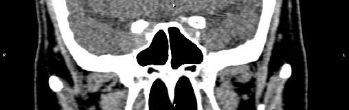File:Bilateral enlargement of lacrimal glands - sarcoidosis (Radiopaedia 62627-70921 Coronal non-contrast 24).jpg