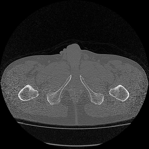 Bilateral femoral neck stress fractures (Radiopaedia 28666-28954 Axial bone window 84).png