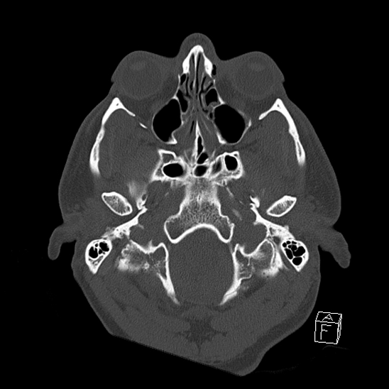 Bilateral occipital condyle fracture (type 2) (Radiopaedia 87675-104089 Axial bone window 16).jpg