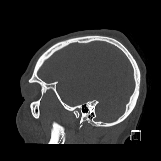 Bilateral occipital condyle fracture (type 2) (Radiopaedia 87675-104089 Sagittal bone window 94).jpg