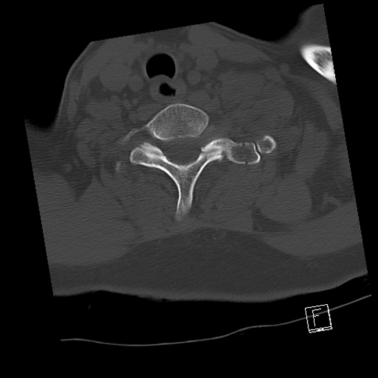 Bilateral occipital condyle fractures (type 3) (Radiopaedia 87672-104086 Axial bone window 65).jpg