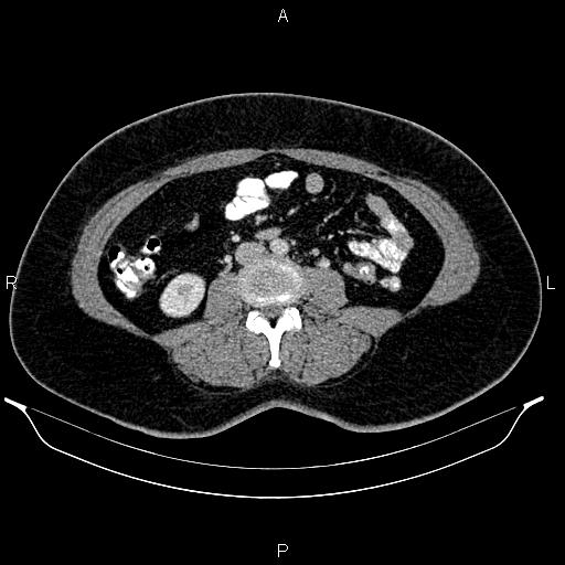 File:Bilateral ovarian dermoid cysts (Radiopaedia 85785-101603 A 60).jpg