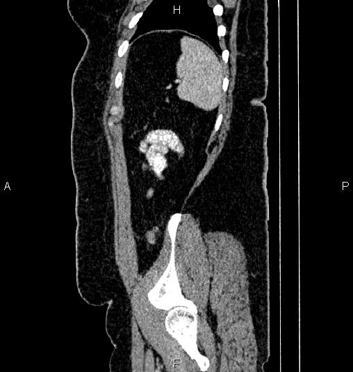 Bilateral ovarian dermoid cysts (Radiopaedia 85785-101603 D 83).jpg