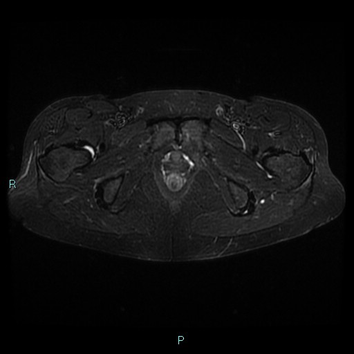 File:Bilateral ovarian fibroma (Radiopaedia 44568-48293 Axial STIR 26).jpg