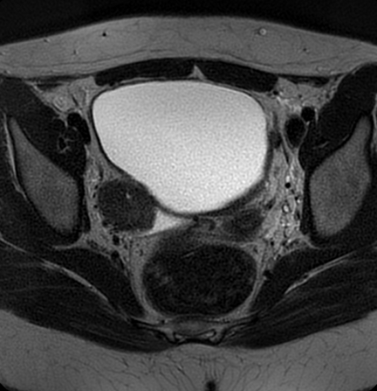 File:Bilateral ovarian fibrothecomas - adolescent (Radiopaedia 86604-102707 Axial T2 26).jpg