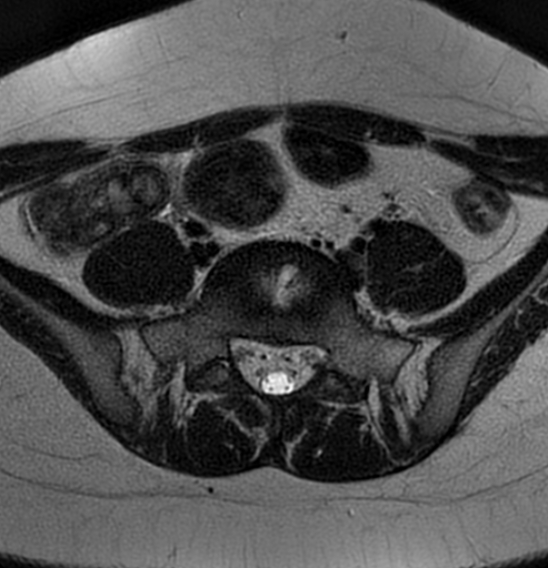 File:Bilateral ovarian fibrothecomas - adolescent (Radiopaedia 86604-102707 Axial T2 5).jpg