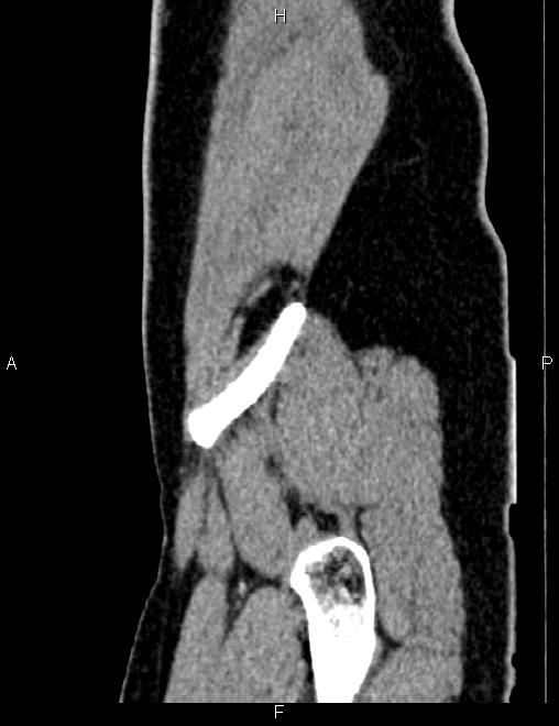 Bilateral ovarian teratoma (Radiopaedia 83131-97503 D 22).jpg
