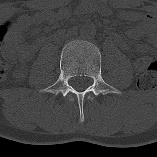 File:Bilateral pars defect (Radiopaedia 26691-26846 Axial bone window 2).jpg