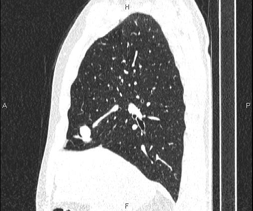 Bilateral pulmonary AVM (Radiopaedia 83134-97505 Sagittal lung window 44).jpg