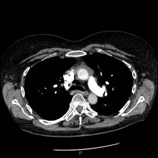 Bilateral pulmonary emboli (Radiopaedia 32700-33669 Axial C+ CTPA 40).jpg