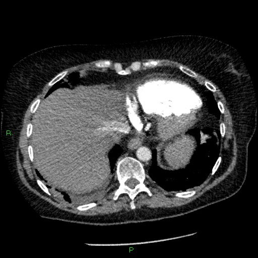Bilateral pulmonary emboli (Radiopaedia 32700-33669 Axial C+ CTPA 89).jpg