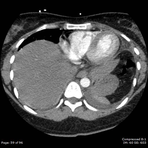 Bilateral pulmonary emboli with Hampton hump sign (Radiopaedia 54070-60246 Axial C+ CTPA 56).jpg