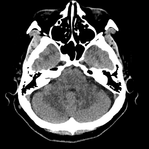 Bilateral subacute subdural hematoma (Radiopaedia 69240-79018 Axial non-contrast 12).jpg
