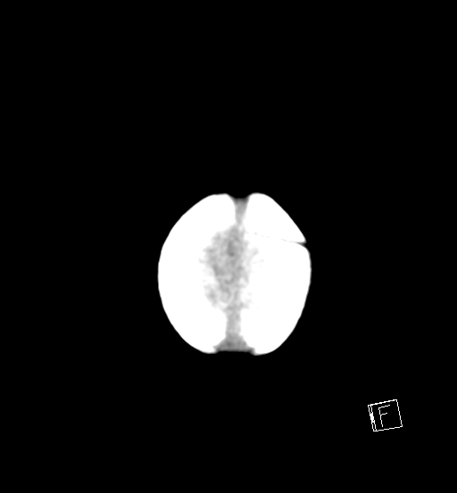 File:Bilateral subdural hemorrhage and parietal skull fracture (Radiopaedia 26058-26192 Axial non-contrast 1).png