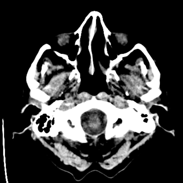 Bilateral subdural hygromata (Radiopaedia 29245-29656 Axial non-contrast 3).jpg
