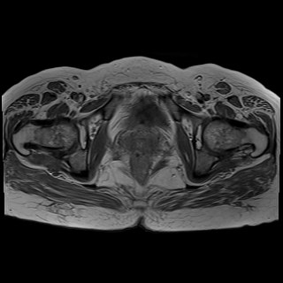 Bilateral tubo-ovarian abscesses (Radiopaedia 58635-65829 Axial T1 C+ 40).jpg