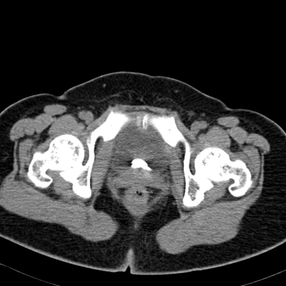 Bilateral ureteric stents (Radiopaedia 48795-53825 Axial non-contrast 67).jpg