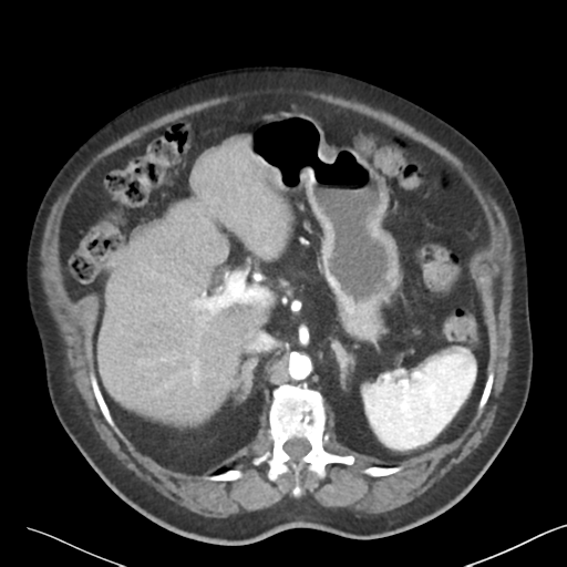 File:Bladder papillary urothelial carcinoma (Radiopaedia 48119-52951 A 12).png