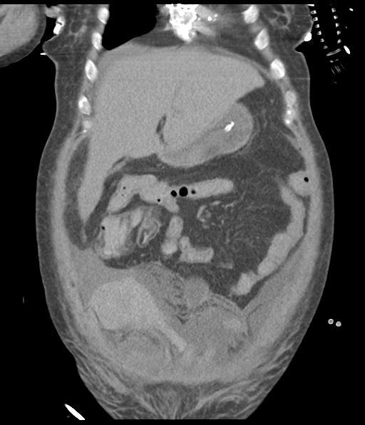 Bladder rupture post renal biopsy (Radiopaedia 30863-31572 Coronal non-contrast 18).jpg
