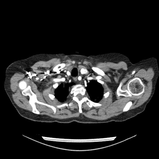 File:Bladder tumor detected on trauma CT (Radiopaedia 51809-57609 A 14).jpg