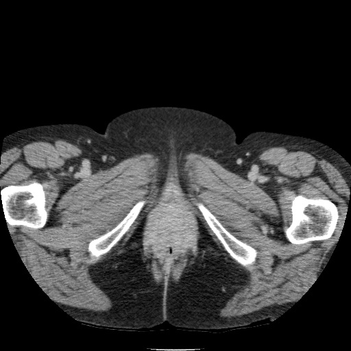 Bladder tumor detected on trauma CT (Radiopaedia 51809-57609 C 150).jpg
